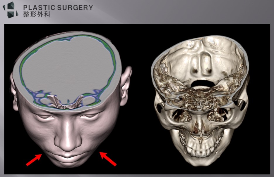 무턱과 하악왜소증의 진단: 3D CT 기반 수술 계획 - 고개를 약간 숙인 모습에서 위 사진과 같이 턱끝 옆으로 하악 체부쪽으로 함몰이 관찰 됩니다.