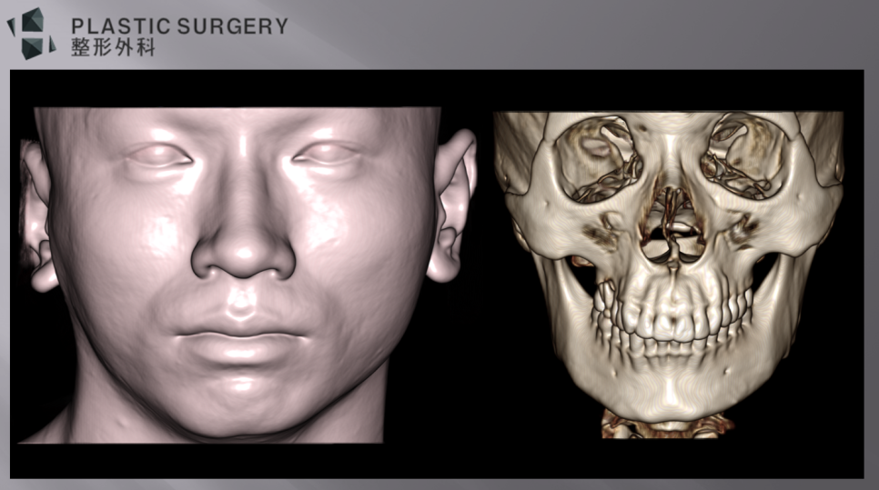 무턱과 하악왜소증의 진단: 3D CT 기반 수술 계획 - 실제 정면 모습과 뼈의 모습입니다. 전반적으로 입이 튀어나와 보이고, 턱끝은 뾰족하지만,