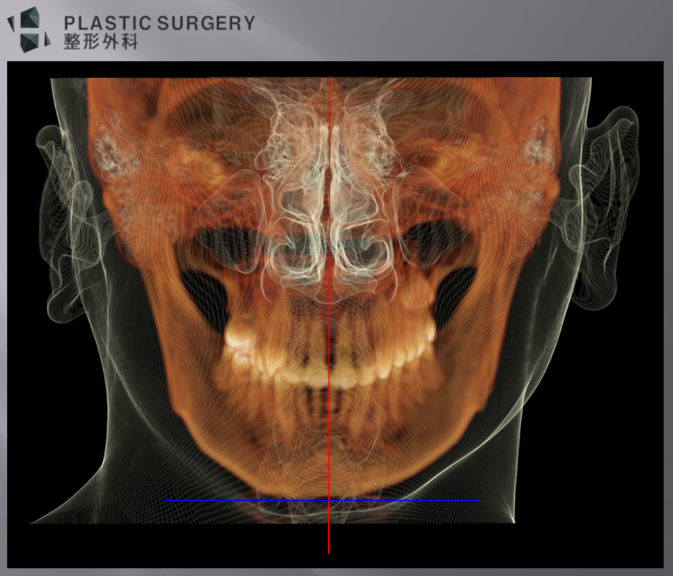 무턱과 하악왜소증의 진단: 3D CT 기반 수술 계획 - 뼈와 피부를 함께 투영한 이미지에서 중심선(빨간색)을 보면, 턱끝이 우측으로 돌아간 모습이 관찰되고, 파란선을 보면,