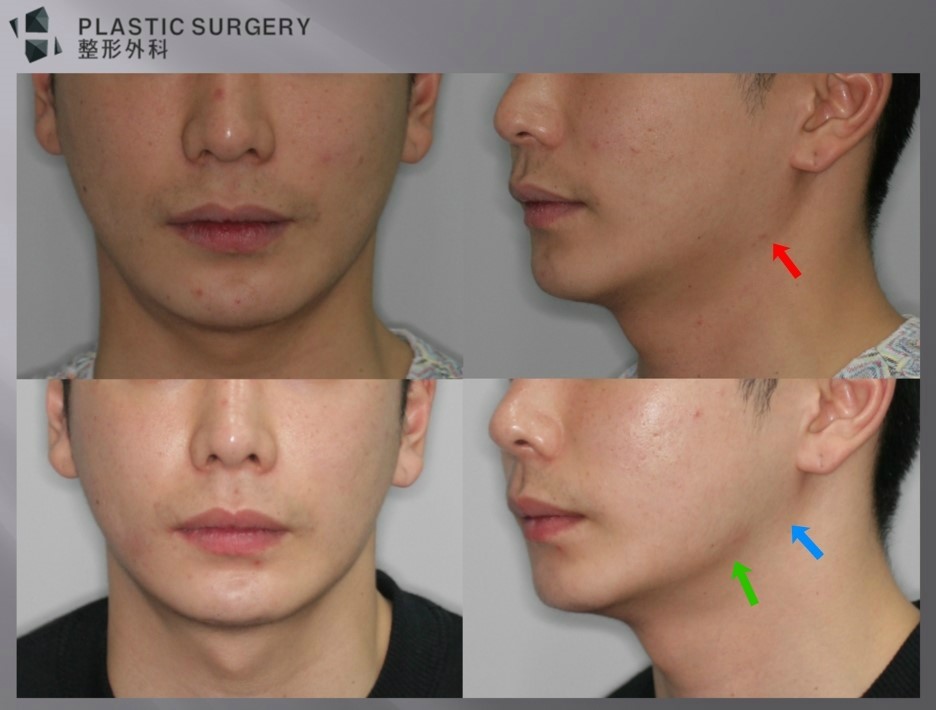 사각턱 재건 전 꼭 알아야 할 점: 반복 재수술의 위험과 회복 - 개인적으로 빨간 화살표 부위의 귀밑각이 더 옳다는 생각입니다. 다만 교근 축소술로 인해 하악각의 측면으로