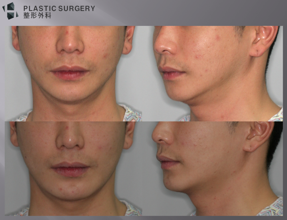 사각턱 재건 전 꼭 알아야 할 점: 반복 재수술의 위험과 회복 - 위쪽의 메드포어 재건 수술모습과 아래쪽 3D Fit PMMA 재건 모습입니다. 하지만, 수술 후 1달이 채 지나지 않아 환자분은