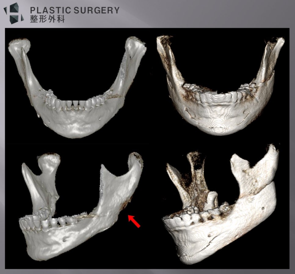 사각턱 재건 전 꼭 알아야 할 점: 반복 재수술의 위험과 회복 - CT 상에서 메드포어는 확연히 구분되지 않지만, 수술 중 제거된 모습을 보면 빨간 화살표 부위에만