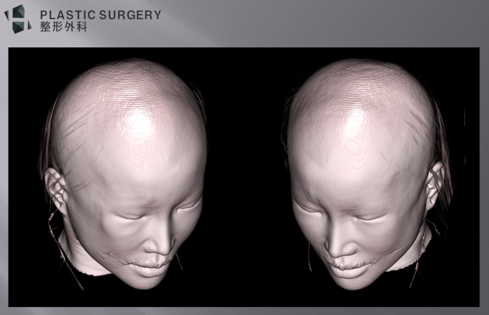 광대 불유합·광대 갭 재수술: 3D 시뮬레이션으로 본 재건 계획 - 피부가 얇은 경우, 항상 보이는 경우도 있고, 피부가 두껍거나 광대 갭이 그리 크지 않은 경우
