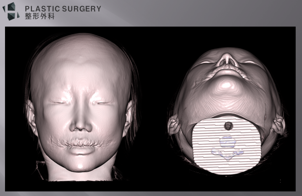 광대 불유합·광대 갭 재수술: 3D 시뮬레이션으로 본 재건 계획 - 위 사진과 같이 양측 광대 부위에 체부 절골라인을 따라서 함몰이 관찰될때