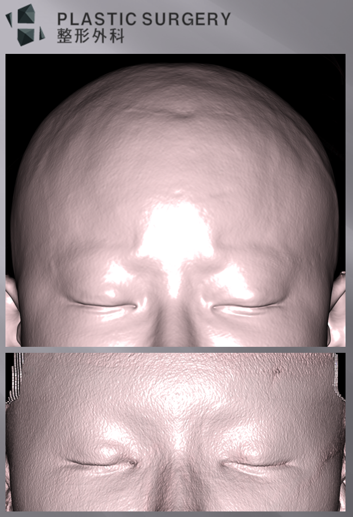 3D 프린팅 이마·미간 성형: 3D Fit PMMA 수술 사례 - 수술 후 피부변화 모습입니다. 미간 부위와 눈썹위 부위의 함몰이 도톰하게 변화된 모습이
