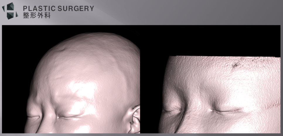 3D 프린팅 이마·미간 성형: 3D Fit PMMA 수술 사례 - 사면 모습에서도 미간부위와 눈썹 위쪽의 함몰이 교정된 모습을 확인할 수 있습니다.