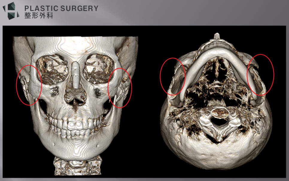 광대뼈 결손 진단과 재건 계획: 퀵광대 후 3D CT 분석 - 정면 모습과 광대활을 잘 보기 위한 3D CT 이미지에서 양측에 발생한