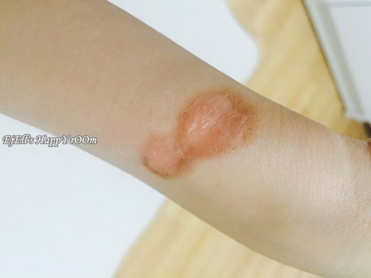 화상연고 추천, 미보연고! : 네이버 블로그