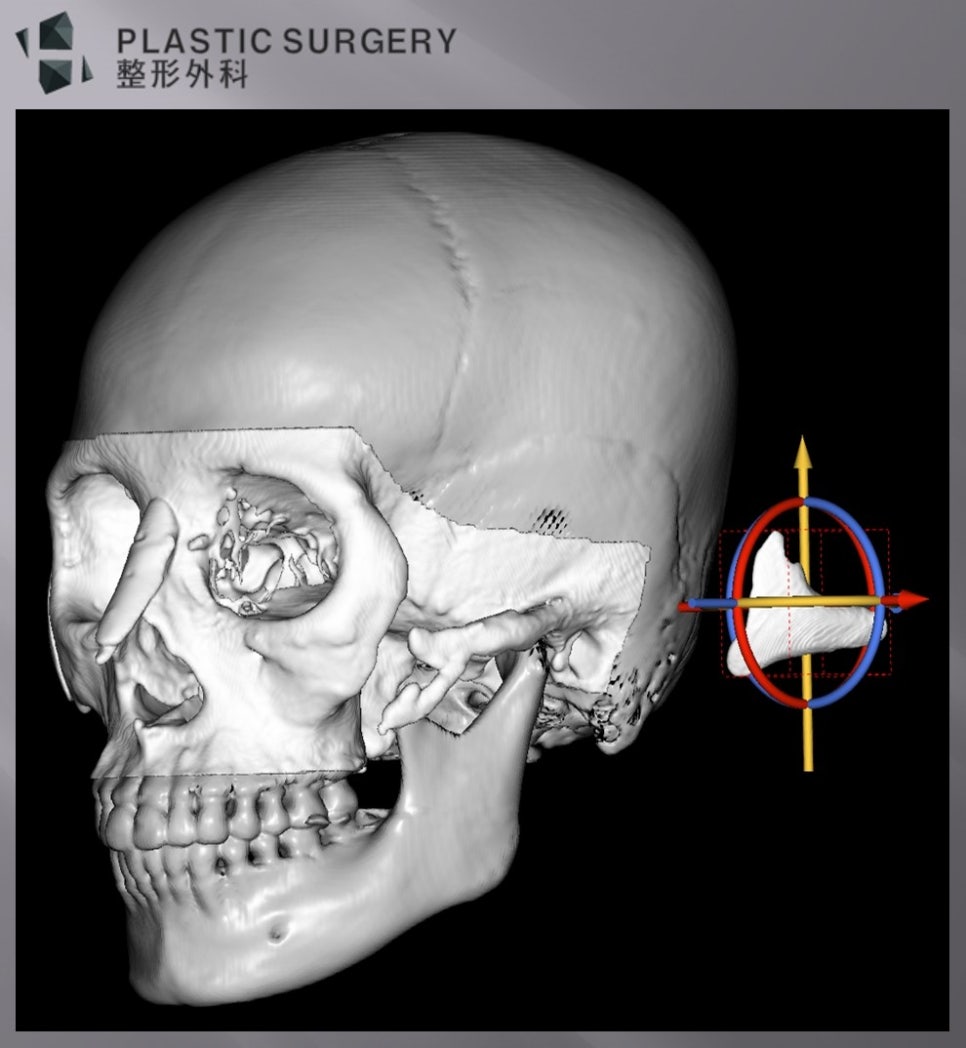 티타늄 광대 재건 계획: 3D 시뮬레이션·맞춤형 보형물 설계 - 반대쪽도 역시 보형물 삽입의 적정성을 확인하게 됩니다. 이렇게 디자인된 보형물과