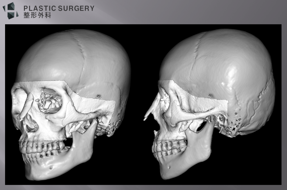 티타늄 광대 재건 계획: 3D 시뮬레이션·맞춤형 보형물 설계 - 보형물이 삽입되었을 때의 환자의 광대 모습입니다. 대칭성 및 삽입가능성 계단 현상등을