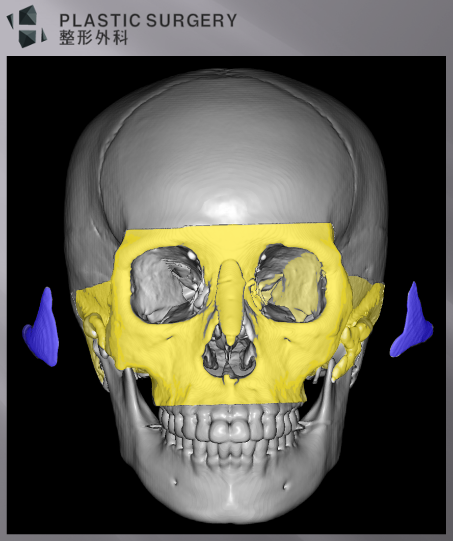 티타늄 광대 재건 계획: 3D 시뮬레이션·맞춤형 보형물 설계 - 위 사진의 노란 영역은 수술에 필요한 광대부위만 분리한 부위 입니다. 이렇게 수술에 필요한 광대 부위만