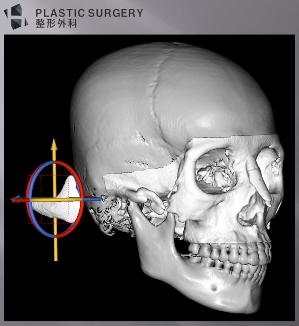 티타늄 광대 재건 계획: 3D 시뮬레이션·맞춤형 보형물 설계 - 디자인된 보형물을 제거하고 삽입시 구조적으로 삽입에 적합한지 확인하는 과정 입니다.