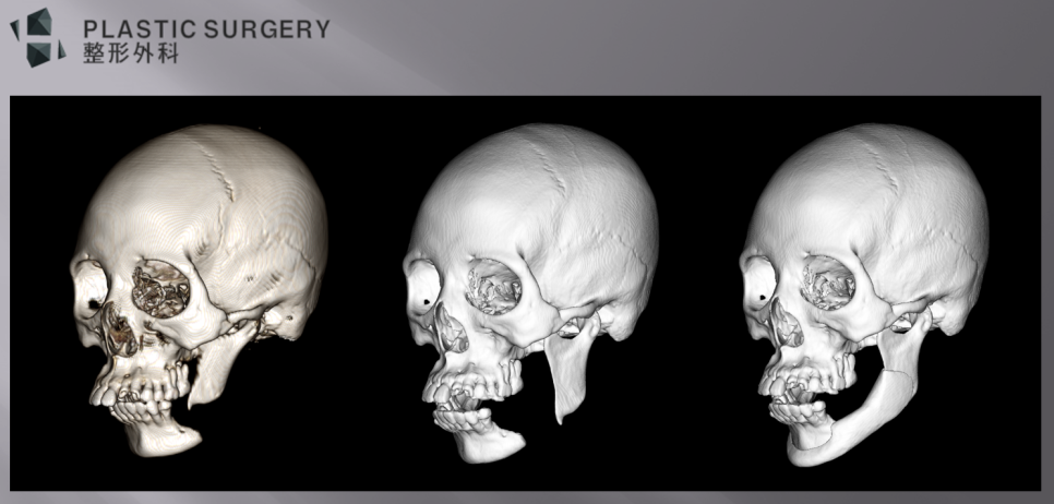 티타늄 하악·사각턱 재건 계획 ②: 3D 정렬과 보형물 설계 - 위 사진은 현재 상태, 재정렬후 모습, 보형물 삽입후 사면 모습입니다. 아직 몇가지 수정 사항과
