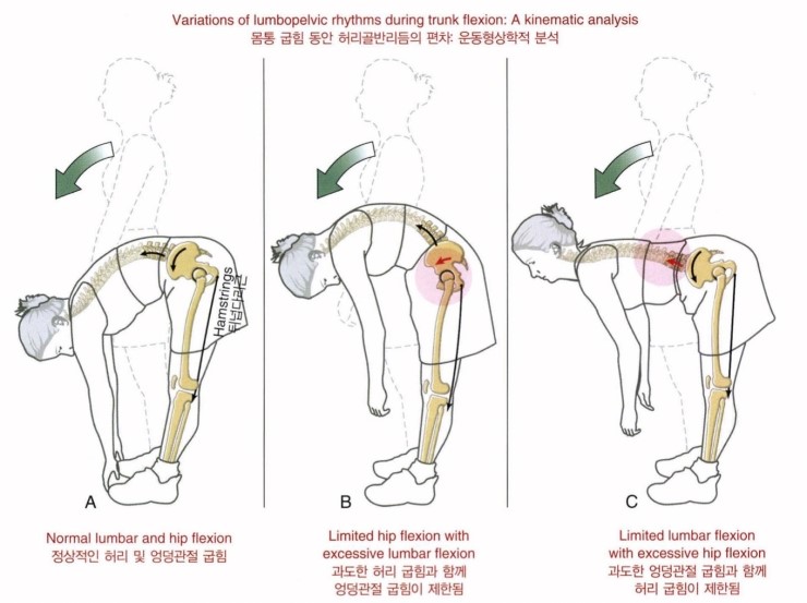 요추 굴곡증후군(lumbar flexion syndrome) : 네이버 블로그