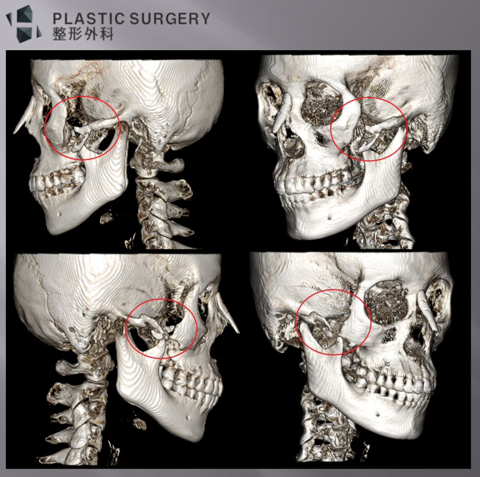 퀵광대 수술 후 뼈 흡수·불유합 위험: 수술 1개월 3D CT 분석 - 위 사진은 앞서 설명드린 환자와 유사한 수술을 받고 10년 정도가 경과한 사진 입니다.