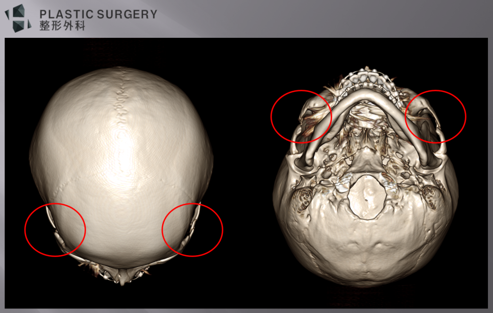 퀵광대 수술 후 뼈 흡수·불유합 위험: 수술 1개월 3D CT 분석 - 우측 광대활 부위에 좌측에 비해 함몰이 많은 모습이 관찰됩니다.