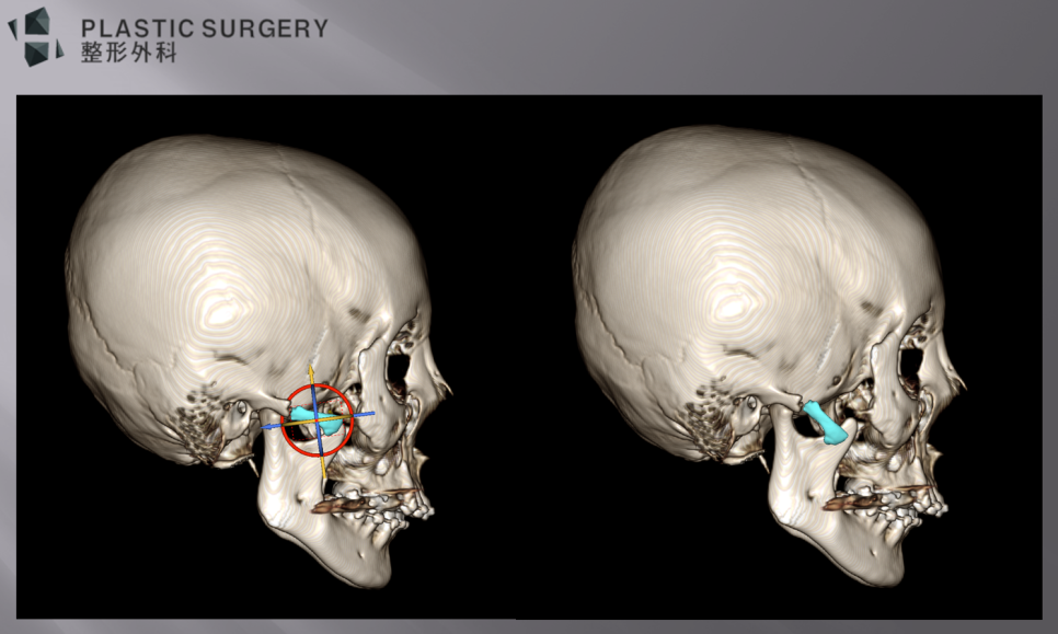 퀵광대 수술 후 뼈 흡수·불유합 위험: 수술 1개월 3D CT 분석 - 현재 모습은 사실 그렇게 나쁘다고 생각하지는 않습니다. 다만, 수술 후 1개월의 현재 모습은 괜찮을 수 있지만,