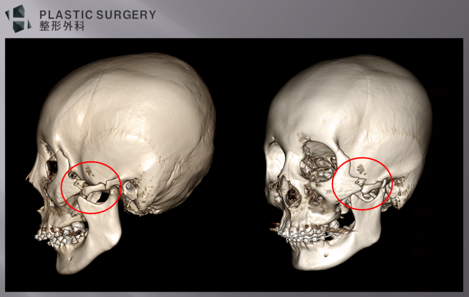 퀵광대 수술 후 뼈 흡수·불유합 위험: 수술 1개월 3D CT 분석 - 좌측면도 역시 골결손 및 광대절편의 하방변위가 발생해 있습니다.