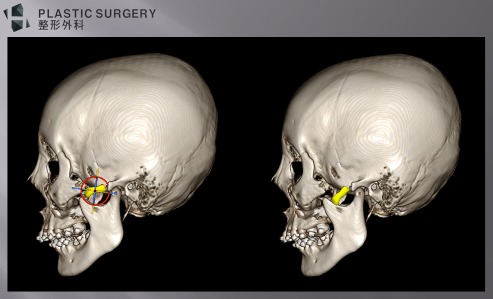 퀵광대 수술 후 뼈 흡수·불유합 위험: 수술 1개월 3D CT 분석 - 좌측면 역시 광대 절편이 교근의 당기는 힘에 의해 하방 변위가 생길 가능성이 높아 보입니다.