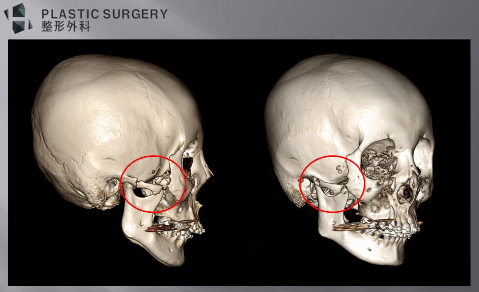 퀵광대 수술 후 뼈 흡수·불유합 위험: 수술 1개월 3D CT 분석 - 우측면에 보이는 광대 체부의 골 결손이 발생해 있습니다.