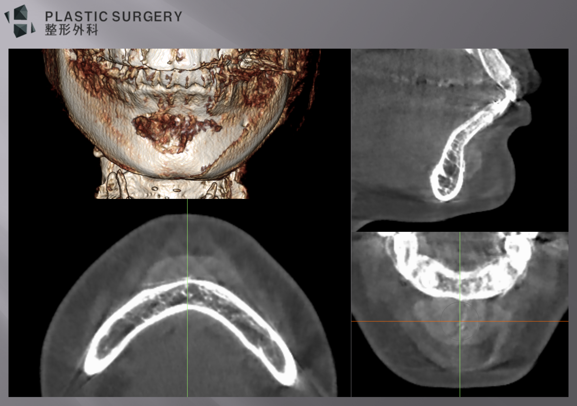 위 환자의 3D CT 입체영상과 