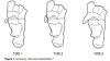 부주상골 증후군(Accessory navicular) : 내측 복사뼈 아래쪽에 통증이 있어요 : 네이버 블로그