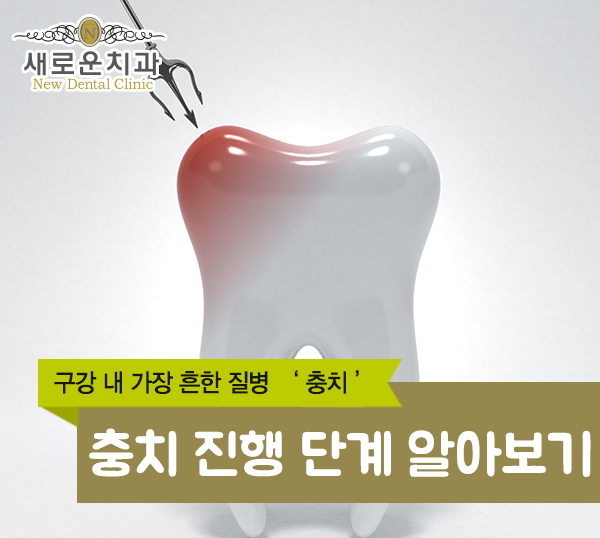충치 진행 단계 알아보기 : 네이버 블로그