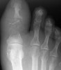 지골 골수염(Phalangeal osteomyelitis) : 무좀을 방치해두었더니 빨갛게 붓고 굉장히 아파요 : 네이버 블로그