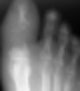 지골 골수염(Phalangeal osteomyelitis) : 무좀을 방치해두었더니 빨갛게 붓고 굉장히 아파요 : 네이버 블로그