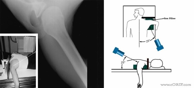 Shoulder X-ray의 Anatomy와 Positioning : 네이버 블로그