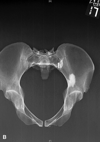Pelvic X-ray의 Anatomy와 Positioning : 네이버 블로그