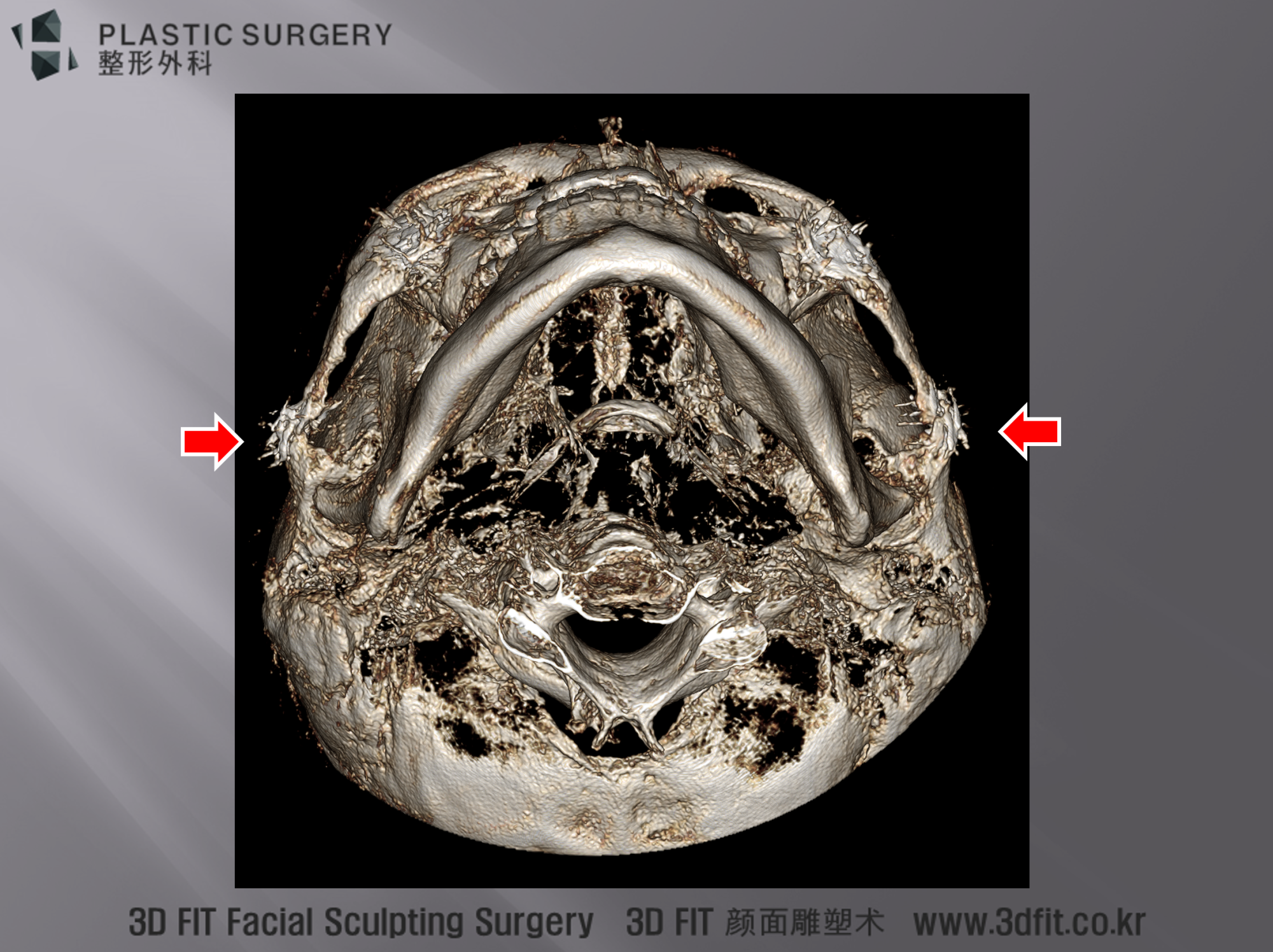 3D CT 상에서도