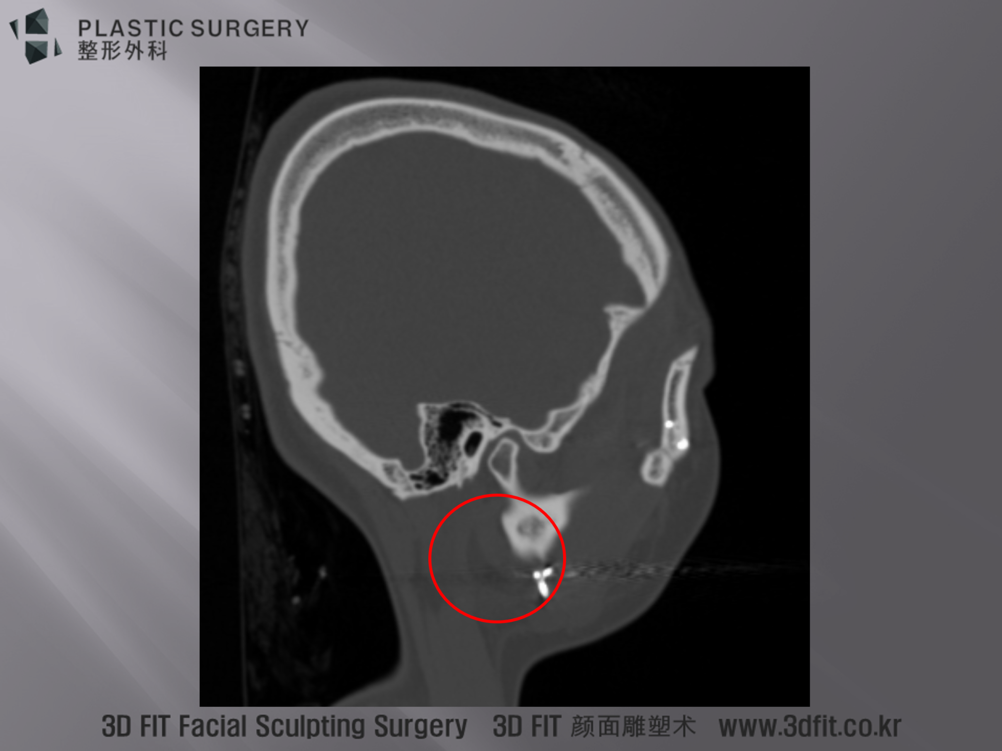 Sagittal 단면 이미지에서 역시 