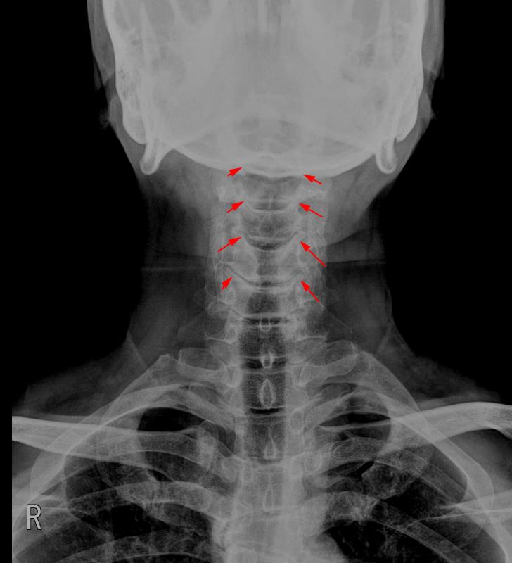 경추 후방 추간공 감압술 Posterior Foramintomy 경추 추간공 협착증의 수술적 치료 Cervical