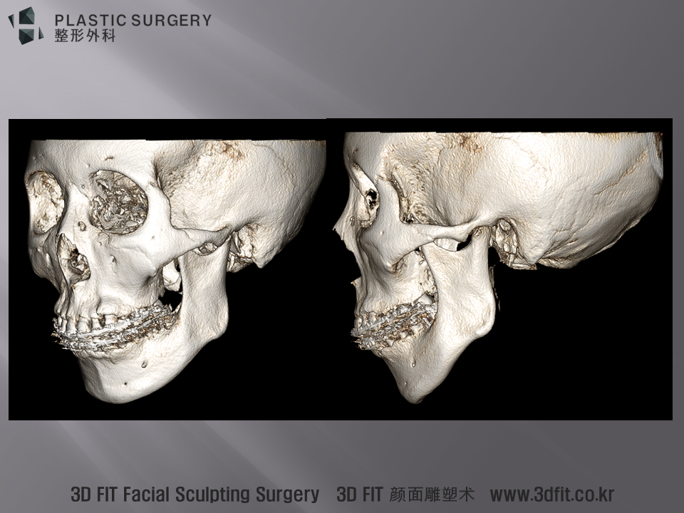 3D CT 에서는 전형적으로 관찰되는 턱끝의 앞뒤길이가 짧은 모습이 관찰되고 있습니다. . 이러한 환자에서 무턱수술 (무턱보형물 or 턱끝전진술) 이 시행되는 경우에는 아래 사진과 같은 투탕카멘의 턱끝과 유사한 모습을 보이게 됩니다.