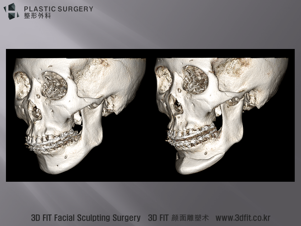 3D CT 상에서 수술 전후 사면 모습입니다.