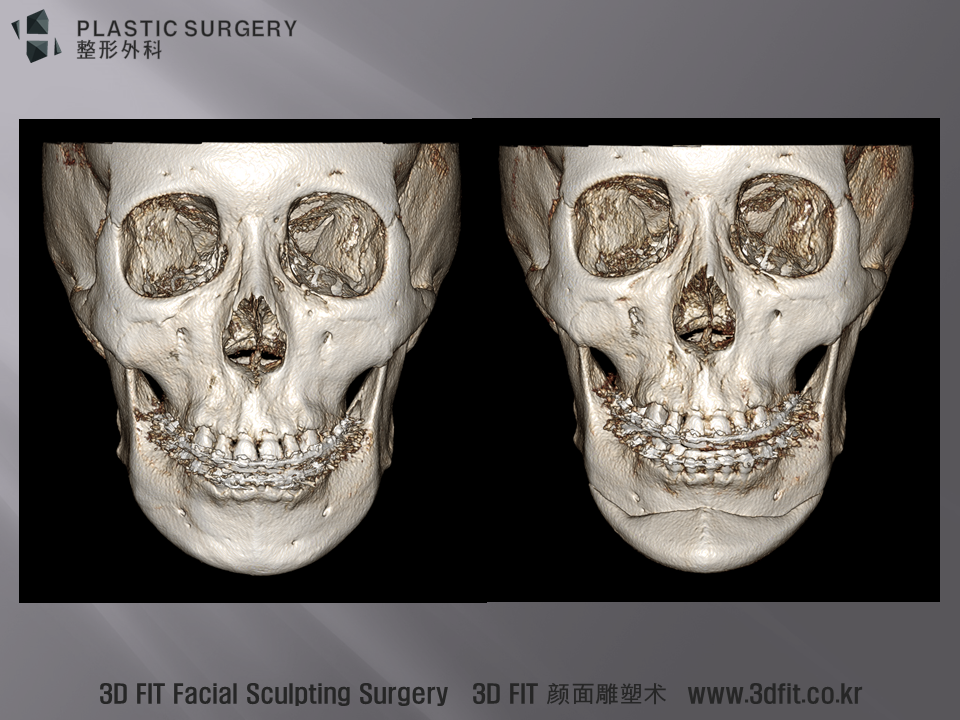3D CT 상에서 수술 전후 정면 모습입니다.