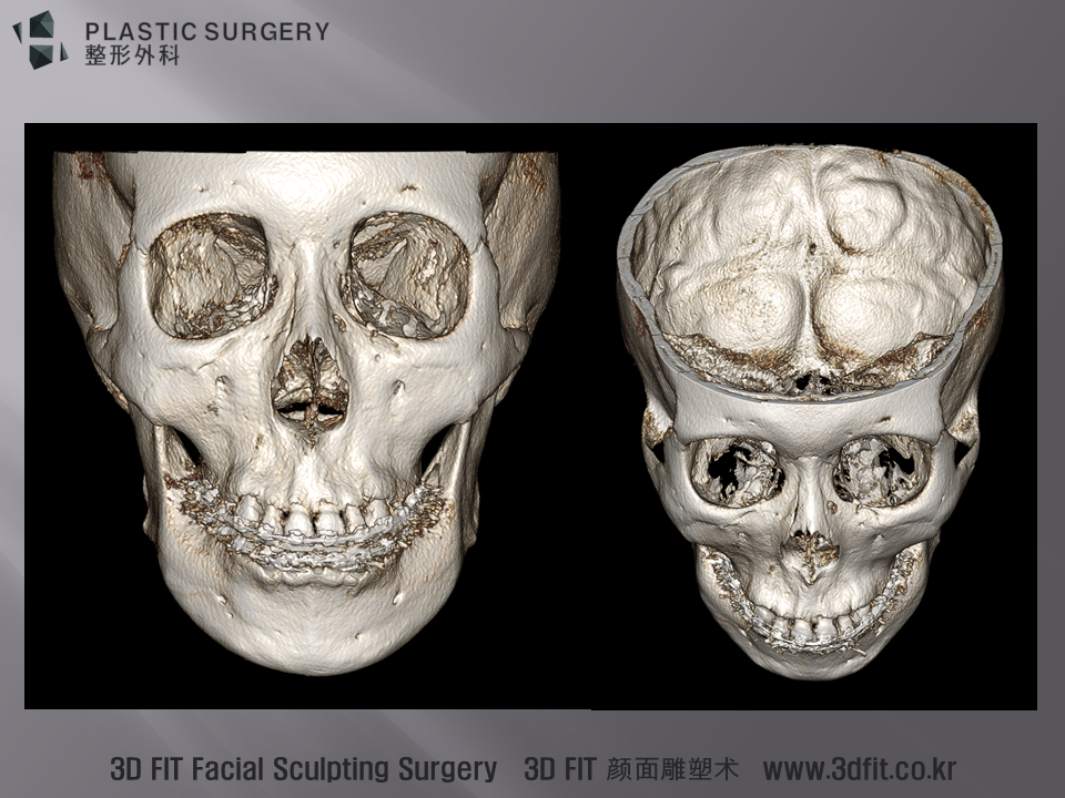 3D CT 모습에서 역시 앞선 사진에서 설명 드린 모습과 크게 다르지 않은 모습이 관찰 됩니다.