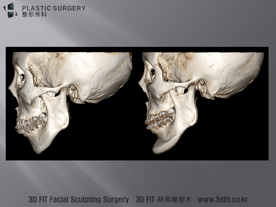 3D CT 상에서 수술 전후 측면 모습입니다. 많은 환자 분들이 무턱과 하악왜소증을 구분하지 못한채 단순히 무턱수술을 받고 제게 다시 내원하시는듯 합니다. 다음 포스팅에서는 턱끝 보형물 수술을 받은 하악왜소증 환자의 실제 예를 통해 설명 드리도록 하겠습니다.