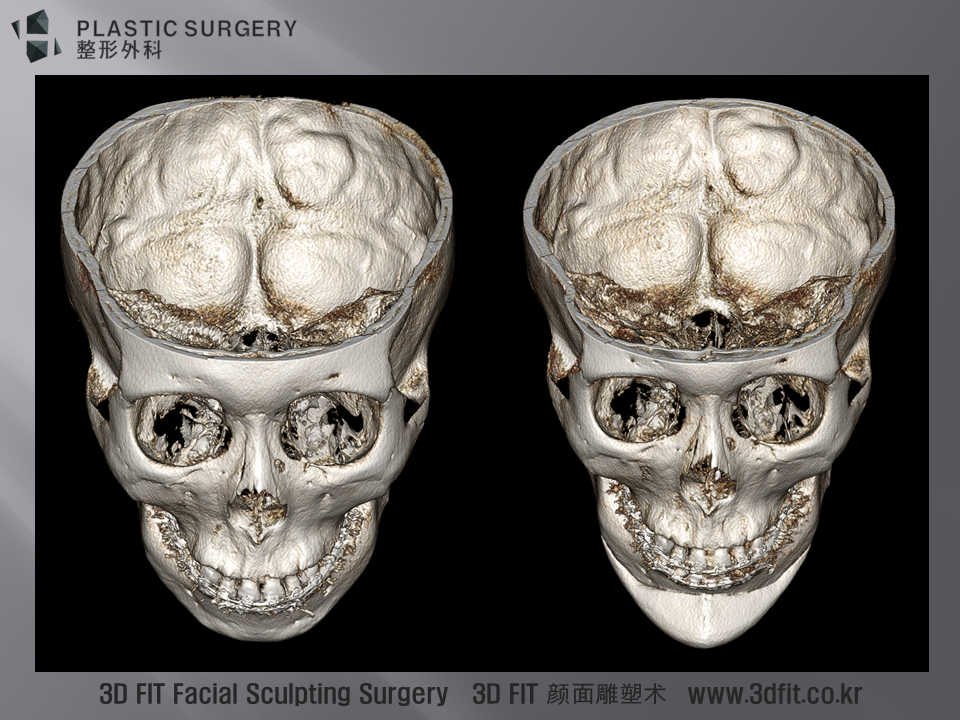 3D CT 상에서 수술 전후 고개를 숙인 모습입니다.