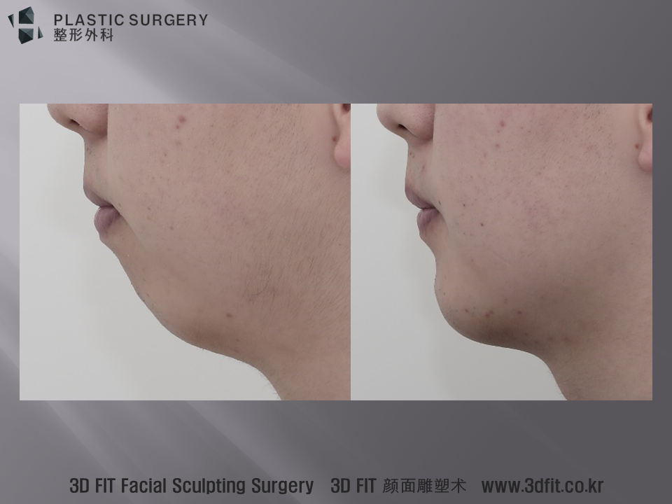 측면에서는 이중턱 느낌이 많이 개선되었고, 턱목각도(Cervicomental angle) 도 정상에 가깝게 만들어진 모습을 볼 수 있습니다.