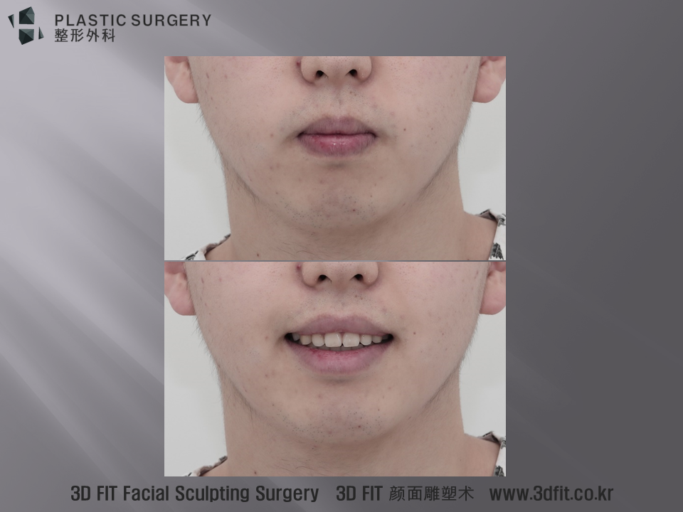 정면모습에서 약간의 비대칭이 관찰되나 고려할 정도는 아님을 확인할 수 있습니다. 다만, 전체 얼굴에 비해 턱이 작고 왜소한 모습이 관찰 됩니다.