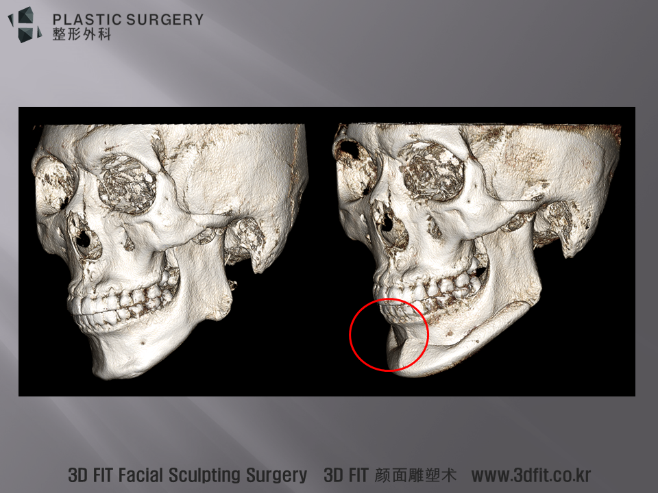 3D CT 사면 모습에서 빨간원 부위에서 보형물의 역할이 실제 모습에서 자연스러움과 함몰을 예방 하고 있음을 확인 할 수 있습니다.