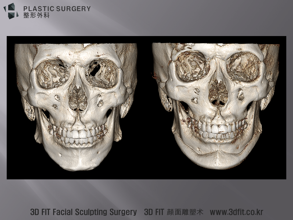 3D CT 에서도 정면모습에서 넓어진 모습을 확인 할 수 있습니다.