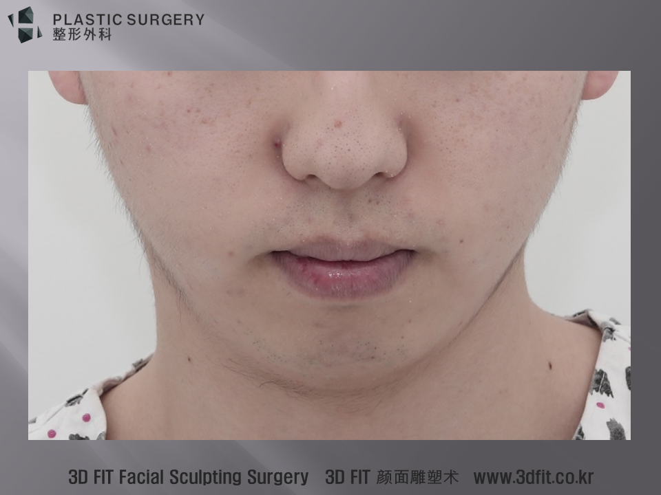 고개를 숙인 모습에서 하악의 돌출이 적고 길이가 짧을 뿐 특별한 함몰은 관찰되지 않습니다. 다만, 하악각과 턱끝의 중간부위인 하악체부에서 약간의 볼륨 부족이 관찰됩니다.