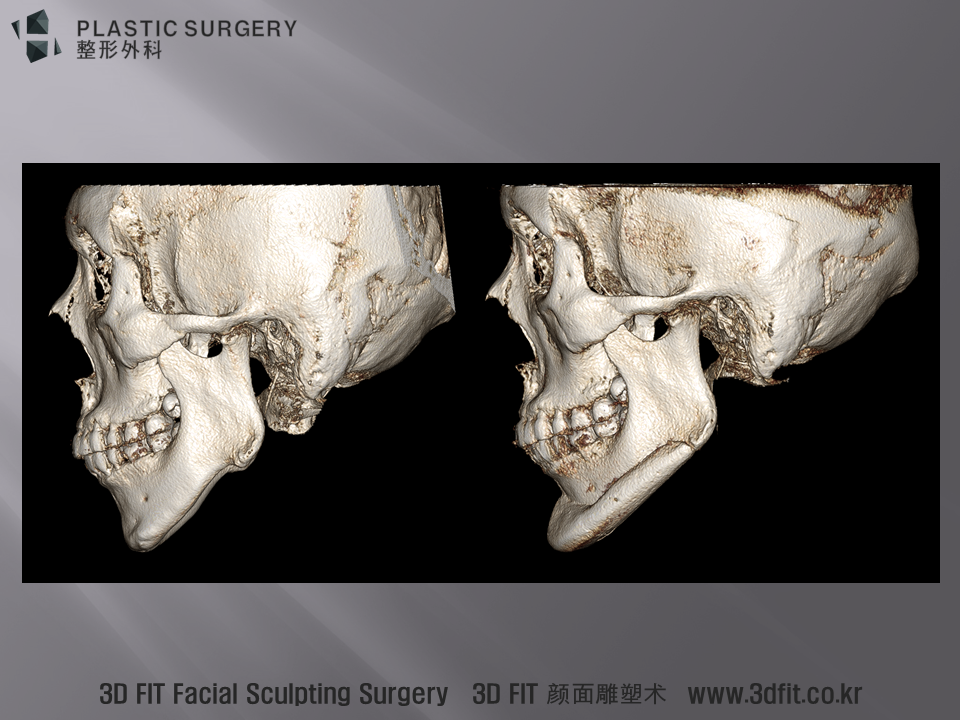 수술 후 측면 3D CT 모습입니다. 보형물과 뼈와 유격 없이 정확하게 삽입된 모습을 확인 할 수 있습니다. 이중턱을 동반한 하악왜소증은 턱끝 전진술이나 턱끝보형물 수술 로는 많은 한계가 있습니다. 특히 동영상에서 강조 드린것과 같이 투탕카멘 느낌을 없애고 자연스럽게 