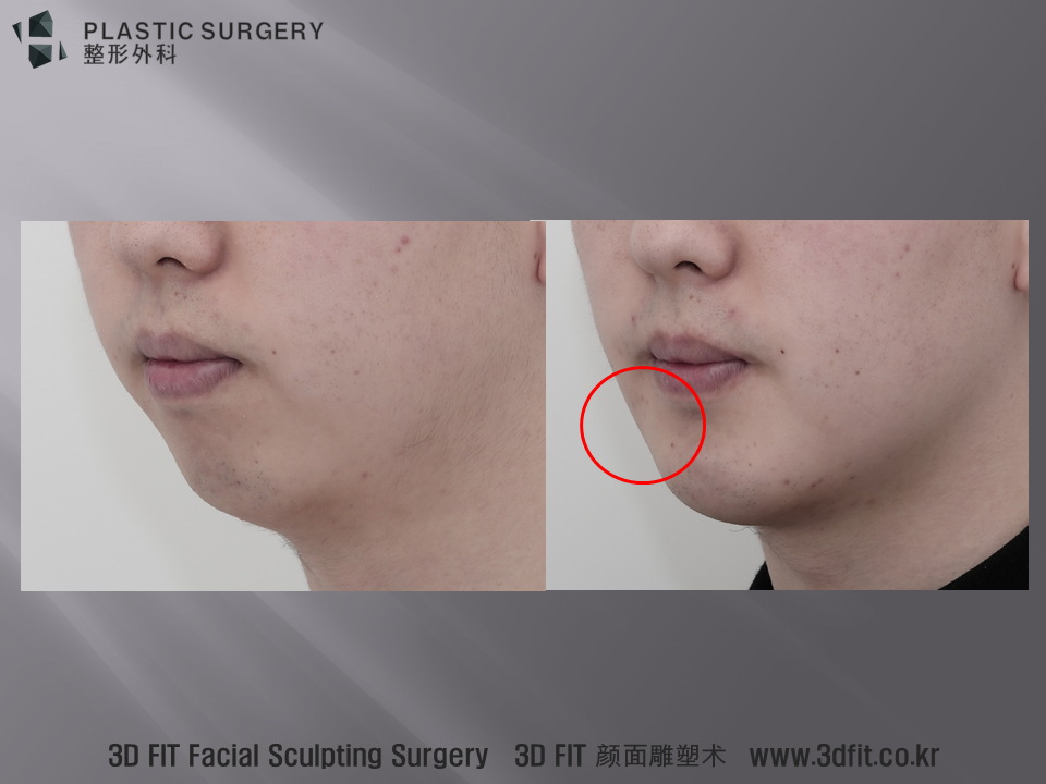 사면 모습에서도 무턱증상은 굉장히 많이 호전되었음을 확인 할 수 있고, 동영상에서 설명드린 빨간 원 부위도 자연스럽게 만들어진 모습입니다.