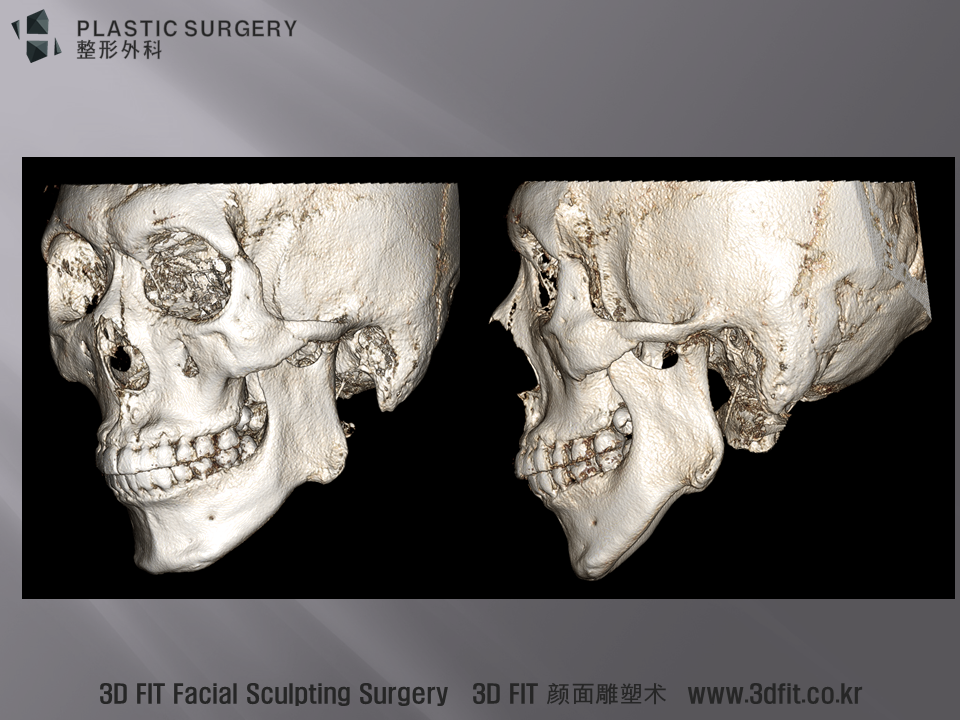 3D CT 모습에서도 턱의 상하길이나 하악각의 각도는 정상적이나 앞뒤길이가 짧아져 있는 모습이 확연히 관찰됩니다. . 위 환자의 수술 전후 사진과 3D CT 설명은 서로이웃추가 후 아래링크에서 확인하시기 바랍니다. http://blog.naver.com/ys100ps/