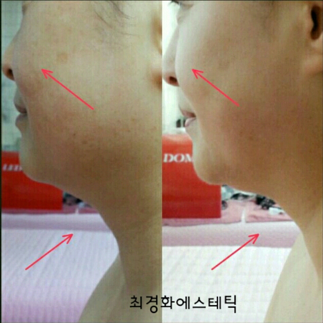 [인천주안역]얼굴축소(경락)관리/비대칭/이중턱/턱근육 중간점검/최경화에스테틱 : 네이버 블로그