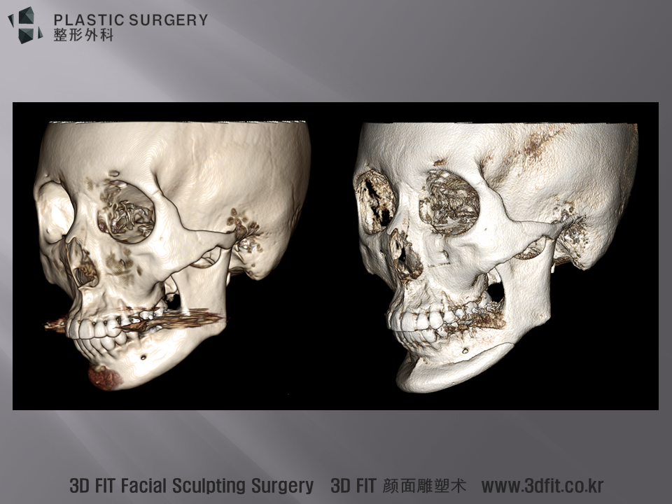 3D CT 사면 모습입니다. 더 많은 전진이 만들어 졌고, 신경선 아래쪽으로 볼륨이 만들어진 모습을 확인 할 수 있습니다.